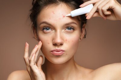 Beyond Skin Deep: Uncovering the True Causes of Stubborn Acne