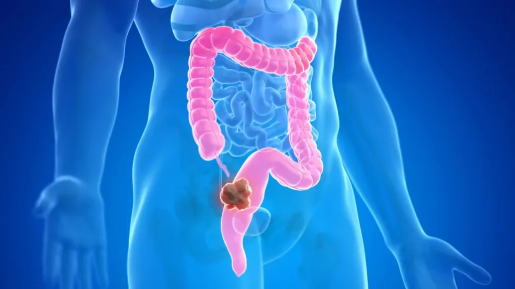 Understanding Colorectal Cancer: Symptoms, Risks, and Early Detection