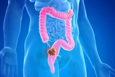 Understanding Colorectal Cancer: Symptoms, Risks, and Early Detection