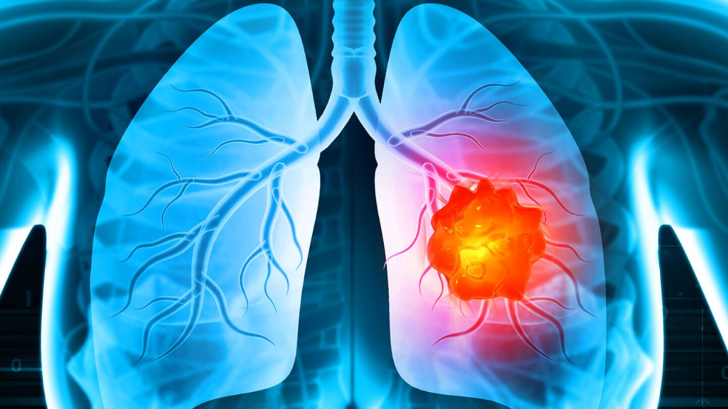 10 Essential Tips for Lung Cancer Prevention