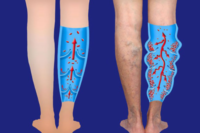 Professions at High Risk for Varicose Veins: What You Need to Know