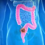 Young adult holding stomach in pain, highlighting rising colon cancer cases in millennials