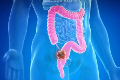 Young adult holding stomach in pain, highlighting rising colon cancer cases in millennials